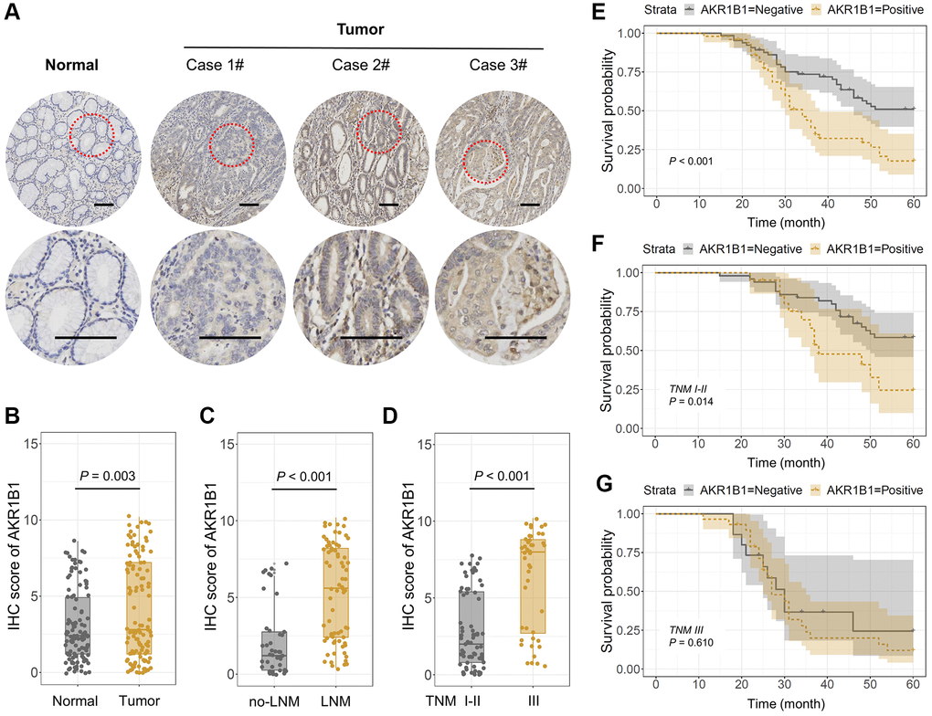 AKR1B1 expression in GC and adjacent normal tissues. (A) The representative IHC images depicting in situ AKR1B1 expression in Case 1#, 2#, 3# GC and adjacent normal tissues (scale bar = 100 μm). (B–E) The IHC scores of AKR1B1 in (B) GC vs. normal tissues, (C) Tumors with or without lymph node metastasis, and (D) TNM stage I–II vs. stage III. (E) The overall survival analysis of AKR1B1pos vs. AKR1B1neg GC patients. (F) In the subgroup of TNM staging I–II, the overall survival analysis of AKR1B1pos vs. AKR1B1neg GC patients. (G) The overall survival analysis of AKR1B1pos vs. AKR1B1neg GC patients in the subgroup of TNM staging III.