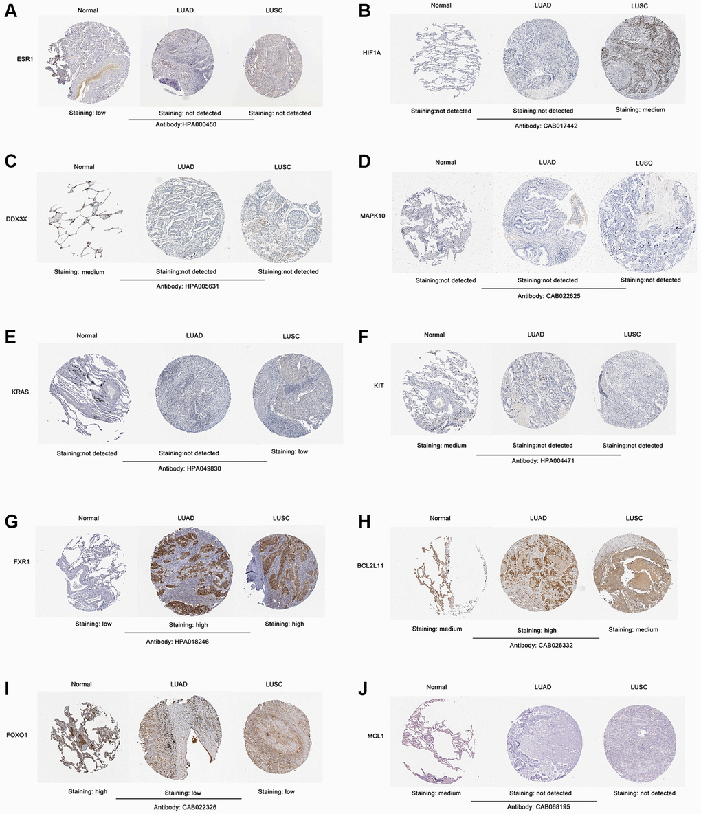 Validation of the protein expression level of screened 10 hub genes in lung cancer samples according to the IHC images in The Human Protein Atlas database. (A) ESR1. (B) HIF1A. (C) DDX3X. (D) MAPK10. (E) KRAS. (F) KIT. (G) FXR1. (H) BCL2L11. (I) FOXO1. (J) MCL1. Abbreviation: IHC: Immunohistochemistry.