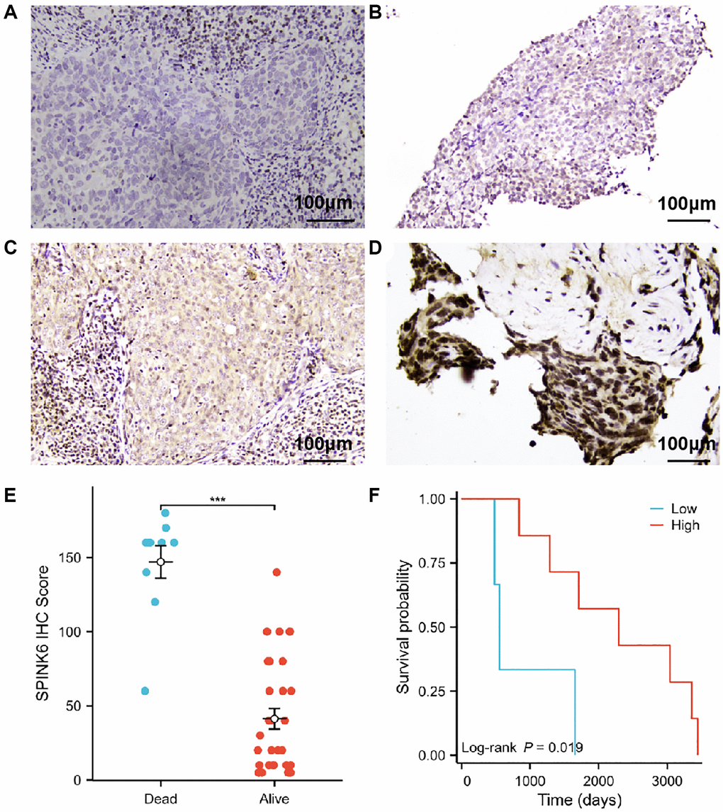 Prognostic significance of SPINK6 protein expression in nasopharyngeal squamous cell carcinoma. (A–D) Representative photomicrographs of SPINK6 protein expression by IHC magnified 200 times under a light microscope. (A) Staining intensity of SPINK6 protein was negative (0). (B) Staining intensity of SPINK6 protein was weak (1+). (C) Staining intensity of SPINK6 protein was moderate (2+). (D) Staining intensity of SPINK6 protein was strong (3+). (E) Comparison of high and low SPINK6 IHC Score groups in validation cohort. (F) KM survival curves of high and low SPINK6 IHC Score groups in validation cohort.
