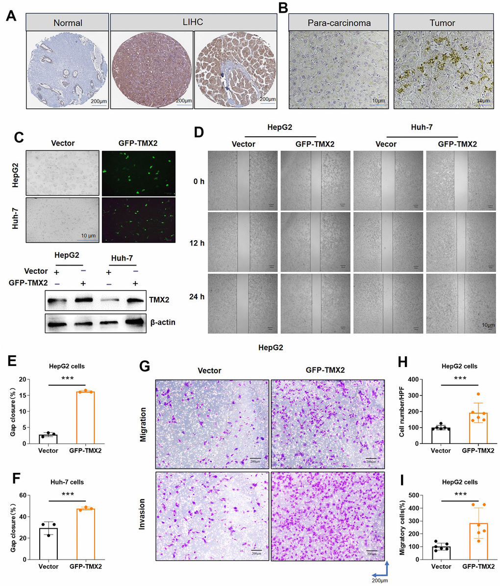 TMX2 overexpression promotes the migration and invasion of liver cancer cells in vitro. Based on the HPA database, representative immunohistochemical staining of TMX2 in normal and tumor tissues of LIHC (A). Immunohistochemical analysis of TMX2 expression intensity in liver cancer patient (B). Transfection analysis of TMX2 (C). Microscopic observations were recorded at 0, 12, and 24 h after scratching the surface of a confluent layer of the indicated HepG2 and Huh-7 cells (D). Quantitative analysis of wound healing percentage in HepG2 cells (E). Quantitative analysis of wound healing percentage in Huh-7 cells (F). The effects of TMX2 on cell migration and invasion were examined by transwell assays in HepG2 cells (G). Quantitative analysis of cell migration in HepG2 cells (H). Quantitative analysis of cell invasion in HepG-2 cells (I). *p 