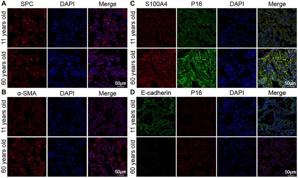Expression of marker proteins in healthy people. (A) Immunofluorescence images showed decreased SPC in lung tissue of the elderly. (B) Immunofluorescence images showed increased α-SMA expression in aging human lung tissue than in young. (C) Double immunofluorescence staining showed that the expression of S100A4 and P16 were significantly higher in aged human lung tissues than in young lung tissues. (D) Double immunofluorescence staining showed that P16 increased in the old and decreased in the young. E-cadherin decreased in the old and increased in the young.