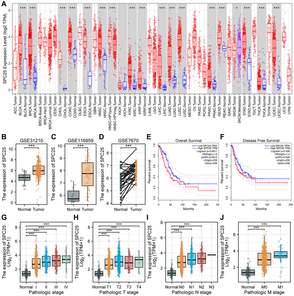 SPC25 expression levels in cancers and prognostic value in LUAD, as well as association with clinicopathological characteristics for LUAD patients. (A) SPC25 levels in different tumor tissues and paracancerous tissues based on the TIMER database. (B–D) SPC25 levels in LUAD samples and normal samples in the (B) GSE31210, (C) GSE116959 and (D) GSE7670. (E, F) Prognostic analysis of SPC25 expression on OS (E) and DFS (F) in LUAD based on the GEPIA database (log-rank test). (G) SPC25 expression was explored in different pathological stages based on the TCGA LUAD database. (H) SPC25 expression was explored in different pathological T stages based on the TCGA LUAD database. (I) SPC25 expression was explored in different pathological N stages based on the TCGA LUAD database. (J) SPC25 expression was explored in different pathological M stages based on the TCGA LUAD database. Abbreviations: TCGA: the Cancer Genome Atlas; LUAD: lung adenocarcinoma; OS: overall survival; DFS: disease free survival. (***p **p *p 