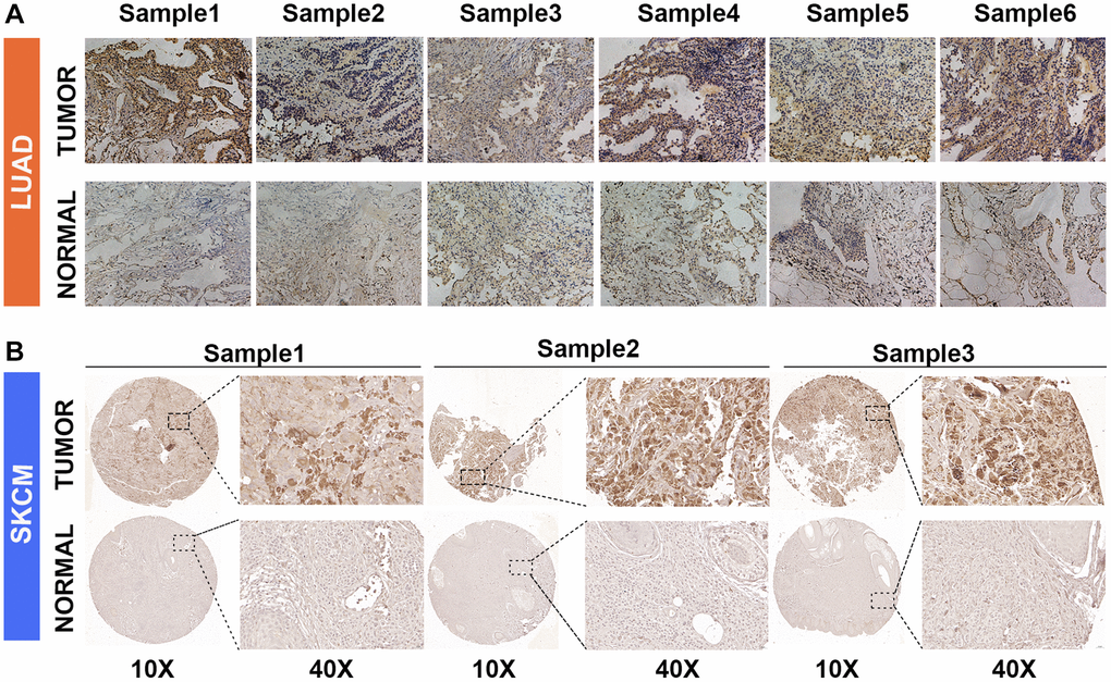 GJB3 expression in non-tumor and tumor tissues based on immunohistochemistry. (A, B) The expression of GJB3 in LUAD (A) and SKCM (B) was higher in cancer tissues than in non-cancer tissues.