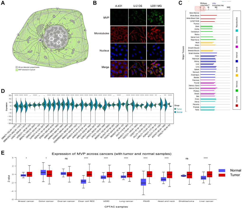 MVP localization, functional chaperone, and expression profiles in normal tissues and cancer. (A) MVP protein is localized in cytoplasm. (B) Immunofluorescence staining to detect the subcellular distribution of MVP in the nucleus, endoplasmic reticulum (ER) and microtubules of A-431 epidermoid carcinoma, U-2 osteosarcoma cells, and U251 glioblastoma. (C) Bar plot of MVP mRNA expression in various normal human tissues. (D) Expression levels of MVP mRNA in 34 different tumor types in the TCGA database via the SangerBox. (E) Expression levels of MVP protein in different tumors and corresponding normal tissues in the UALCAN portal. nsP ≥ 0.05, *P **P ***P ****P 