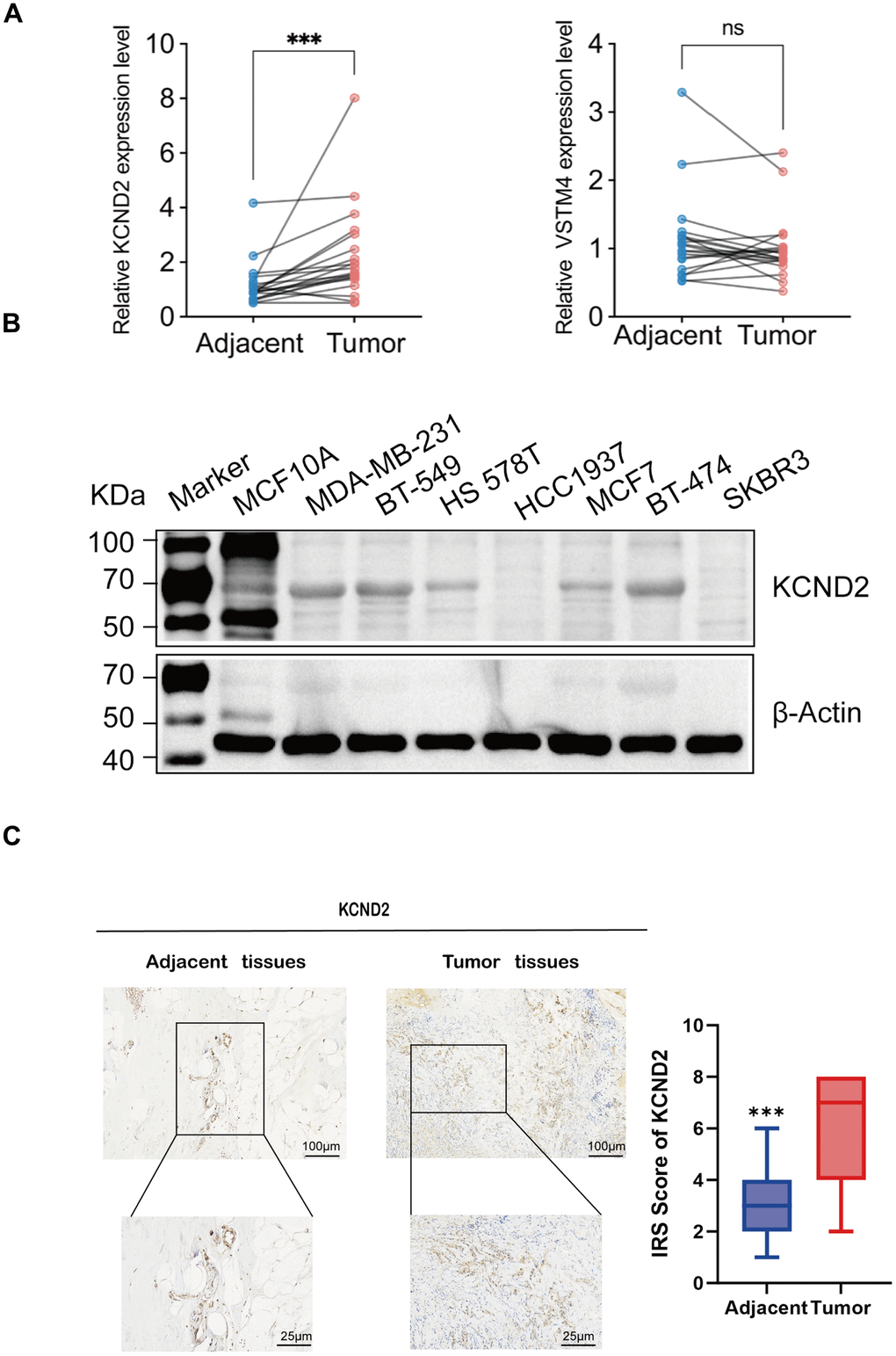 Validation of biomarkers. (A) The mRNA expression of KCND2 and VSTM4 in 20 pairs of tissues, including TNBC adjacent cancer and tumor tissues. (B) The protein expression of KCND2 was verified in cell lines. (C) The expression of KCND2 in the TNBC adjacent cancer and tumor tissues was verified by immunohistochemistry. NS, no significance; ***P 