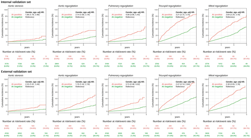 Long-term incidence of developing severity stratified by AI classification using ECG alone. Long-term incidence of developing each moderate-to-severe valvular disease in patients with initially minimal-to-mild valvular diseases stratified by AI classification using ECG alone. Long-term outcome of patients with echocardiographic minimal-to-mild valvular diseases at the time of initial classification, stratified by the initial network classification. The ordinate shows the cumulative incidence of developing moderate-to-severe valvular diseases, and the abscissa indicates years from the time of index ECG–TTE evaluation. A significantly higher risk of future moderate-to-severe valvular diseases was present when the AI algorithm defined the ECG as positive compared with patients with minimal-to-mild valvular diseases who were classified as having a negative finding by the ECG network. The analyses were conducted in both internal and external validation sets. The table shows the at-risk population and cumulative risk for the given time intervals in each risk stratification.
