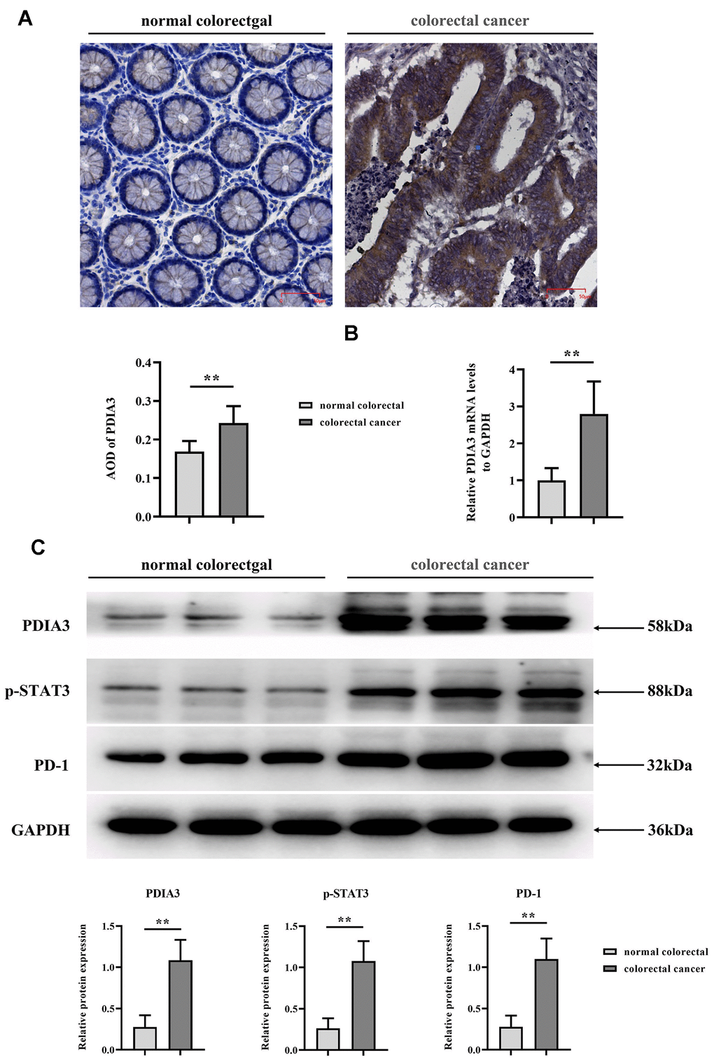 Elevated levels of PDIA3, phosphorylated STAT3 (p-STAT3), and PD-1 are present in CRC tissues. (A) Immunohistochemical assessment of PDIA3 protein in CRC and adjacent normative tissue. Statistical evaluation via T-test* *P B) RT-qPCR quantification of PDIA3 mRNA in CRC and normative tissue (n=96 pairs). Statistical evaluation via T-test,* *P C) Total protein isolation from tumor specimens with RIPA buffer, subsequently quantified via the BCA assay. Relative protein expression levels of PDIA3, p-STAT3, and PD-1 were determined after densitometric analysis from three independent samples. Statistical evaluation via T-test, * *P 