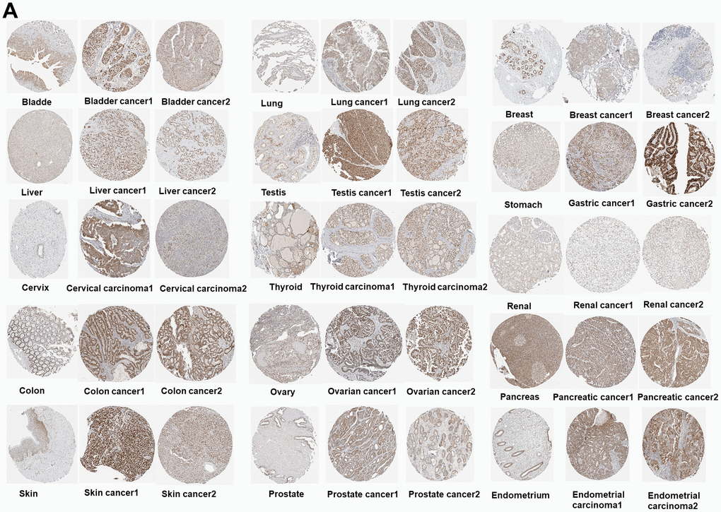 (A) Immunohistochemical images of the normal (left) and tumor (right) group with PUS7 protein expression.