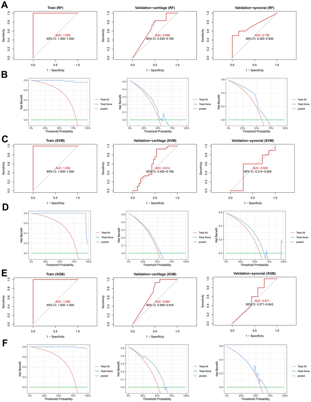 The predictive performance of the RF, SVM, and XGB diagnosis models. (A, B) ROC (A) and DCA (B) analysis indicates the predictive performance of RF model in the training (left), validation-cartilage (middle), and validation-synovial (right) cohorts. (C, D) ROC (C) and DCA (D) analysis indicates the predictive performance of SVM model in the training (left), validation-cartilage (middle), and validation-synovial (right) cohorts. (E, F) ROC (E) and DCA (F) analysis indicates the predictive performance of XGB model in the training (left), validation-cartilage (middle), and validation-synovial (right) cohorts. Abbreviations: RF, random forest; SVM, supporter vector machine; XGB, XGBoost; AUC, area under curve; CI, confidence interval.