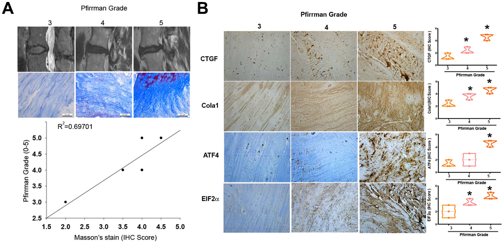 Higher levels of fibrotic markers in high-grade IVDD patients. (A) MRI images and Masson’s trichrome staining of disc tissues from IVDD patients. (B) IHC staining (n=3) was performed for CTGF, Col1a1, ATF4 and EIF2 levels in disc tissues from IVDD patients, followed by photography and quantification. * p 