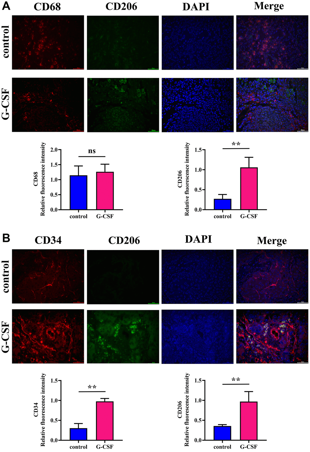 Assessment of M2-type macrophage expression and angiogenic quantification in neoplastic tissues via immunofluorescence. (A) Detection of Mannose (depicted in green)/CD68 (depicted in red) expression levels within neoplasm-bearing tissues. (B) Detection of CD34 (depicted in red)/Mannose (depicted in green) expression levels within neoplasm-bearing tissues. The P-value is less than 0.05.