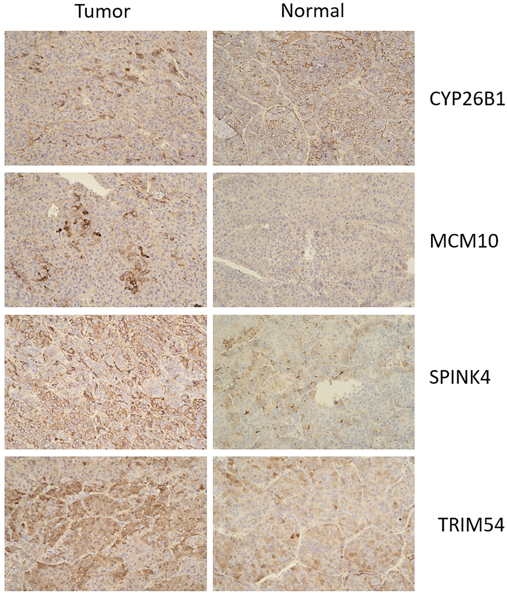 Immunohistochemistry of CYP26B1, MCM10, SPINK4, and TRIM54 expression in tumor tissue and normal tissue.