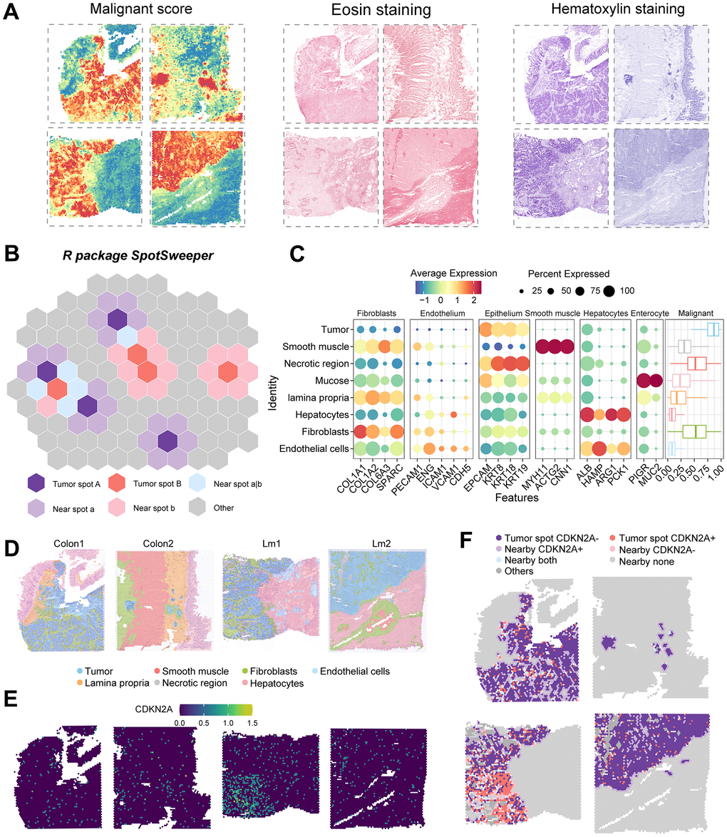 Regional annotation and expression of CDKN2A in spatial transcriptomic samples. (A) Malignancy scores on colorectal cancer spatial transcriptomic samples and on two types of tumor tissue stained with H&E. (B) Analysis of colorectal cancer spatial transcriptomic samples using the SpotSweeper R package. (C) Marker gene expression of all cell types in the tissues. Color depth represents the average expression level, and dot size represents the percentage of expressing cells. (D) Annotation of results from all sample regions, with different colors representing different regions. Sample numbers are listed above. (E) Expression of CDKN2A in colorectal cancer tissues. (F) Expression of CDKN2A in tumor regions and adjacent regions.