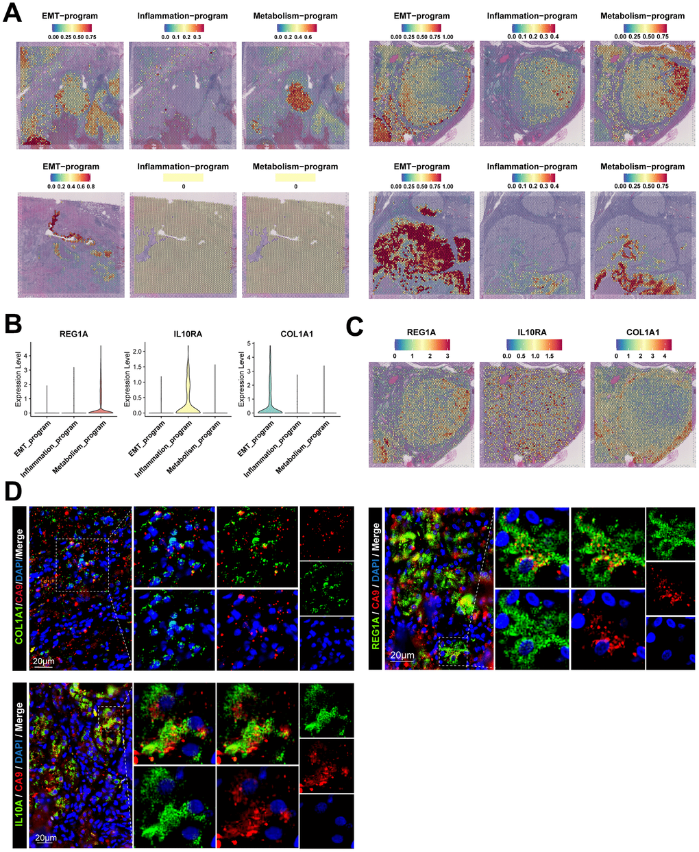 Spatial location information and signature gene characteristics of functionally heterogeneous cancer cells in ccRCC. (A) Spatial location information of functionally heterogeneous cancer cells revealed by stRNA-seq, illustrating the distribution of cancer cells in tumor lesions. (B) Signature gene characteristics of functionally heterogeneous cancer cells in scRNA-seq data, showing the expression levels of signature genes of different meta programs. (C) Spatial expression patterns for signature gene characteristics of functionally heterogeneous cancer cells in stRNA-seq data. (D) Signature gene characteristics of functionally heterogeneous cancer cells validated by clinical samples of ccRCC using immunofluorescence.