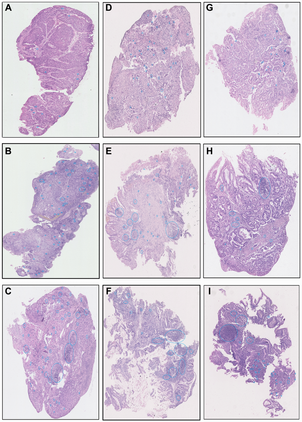 The examples images of low, medium, and high TILs intensity in ESCC (A–C), AEGJ (D–F), and GAC (G–I) H&E-stained tissue sections (H&E×200).