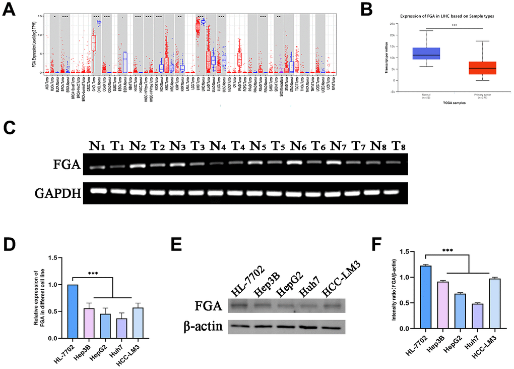 FGA is underexpressed in liver cancer tissue. (A) Analysis of differential FGA expression between liver cancer and adjacent non-cancerous tissues using TCGA RNA-seq data through the TIMER database. (B) Evaluation of FGA expression levels in hepatocellular carcinoma using UNCLAN data. (C) Detection of FGA expression in eight cases of adjacent non-cancerous tissue and eight cases of liver cancer tissue through agarose gel electrophoresis assay. (D) Detection of FGA mRNA expression in normal liver cell line HL-7702 and different liver cancer cell lines using RT-qPCR. (E) Detection of FGA protein expression in normal liver cell line HL-7702 and different liver cancer cell lines using Western blot, and its quantitative analysis. (F) (N: normal tissue, T: tumor tissue; two-tailed Student’s t test; mean ± SD, n = 3; *P 