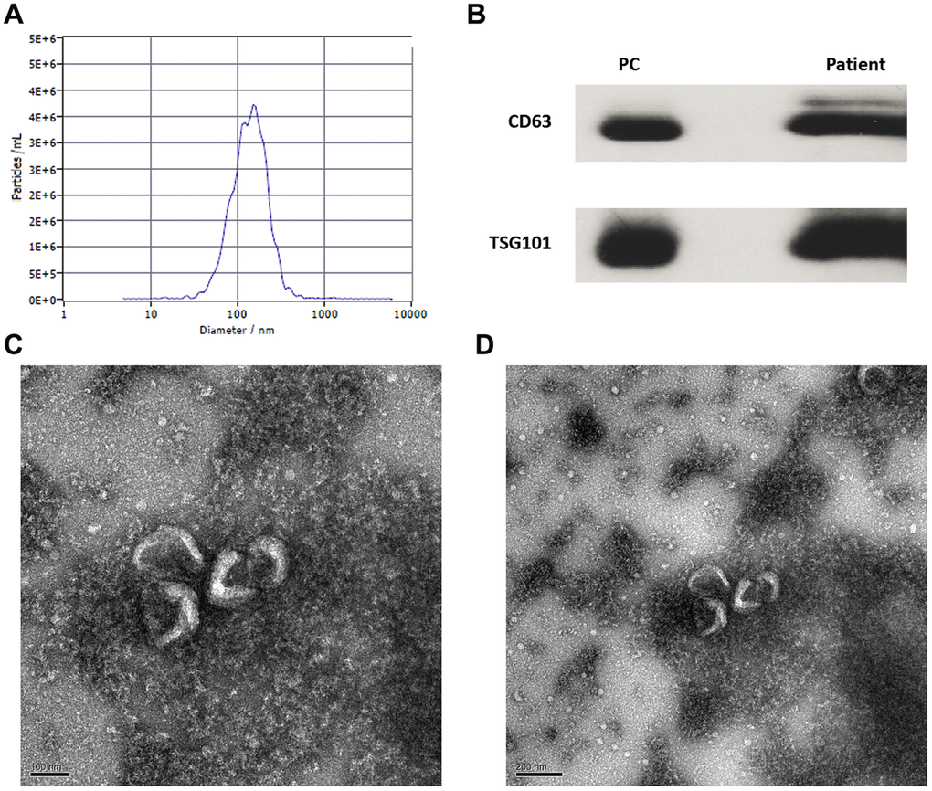 Identification and isolation of circulating exosomes of patients with CHB and hepatocellular carcinoma. (A) The particle size and concentration distribution of exosomes; (B) The wb images of CD63 and TSG101 markers (PC: positive control); (C) The exosomes observed by transmission electron microscope (100 nm); (D) The exosomes observed by transmission electron microscope (200 nm).