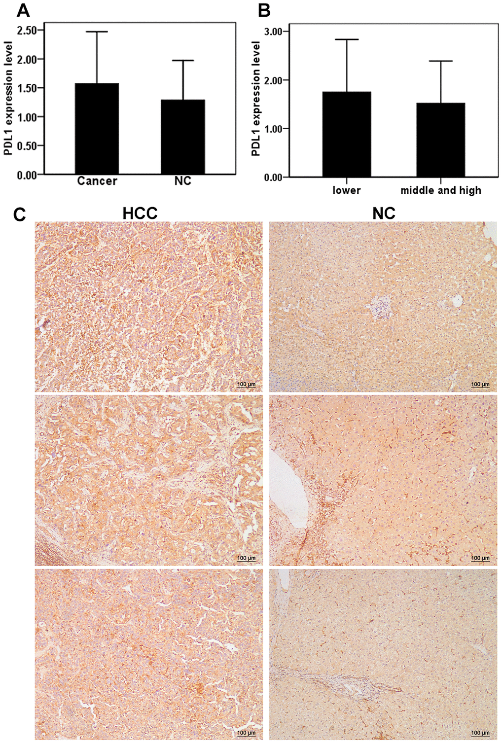 Expression of PD-L1 in cancer tissues and adjacent tissues of HCC patients. (A) The level of PD-L1 in hepatocellular carcinoma and adjacent tissues; (B) Relationship between the levels of PD-L1 and differentiation of hepatocellular carcinoma; (C) Repressive images of PD-L1 expression in hepatocellular carcinoma and adjacent tissues.