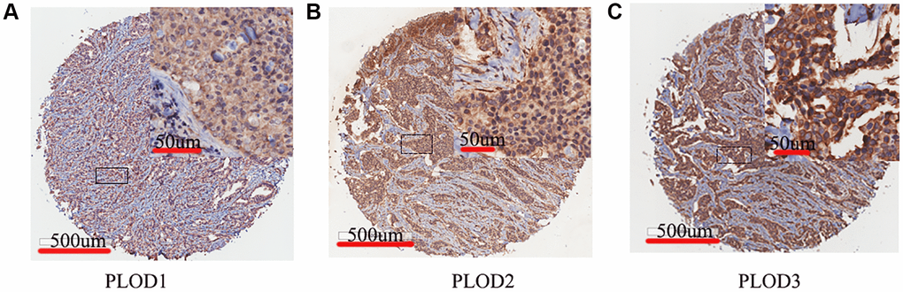 Representative IHC staining of PLOD family genes in breast cancer. Brown staining in cytomembrane and plasm indicates positive staining. (A) PLOD1; (B) PLOD2; (C) PLOD3.
