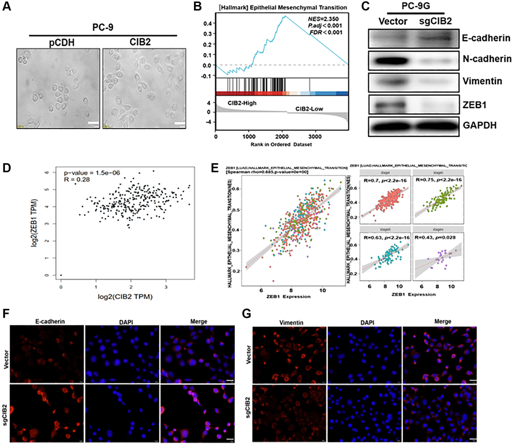 CIB2 increases the expression levels of ZEB1, EMT-associated marker to promote gefitinib resistance. (A) Morphological changes were tracked by microscopy in CIB2-overexpressed cells. Scale bar = 100 μm (×400 magnification). (B) GSEA program was used to analyze HALLMARK