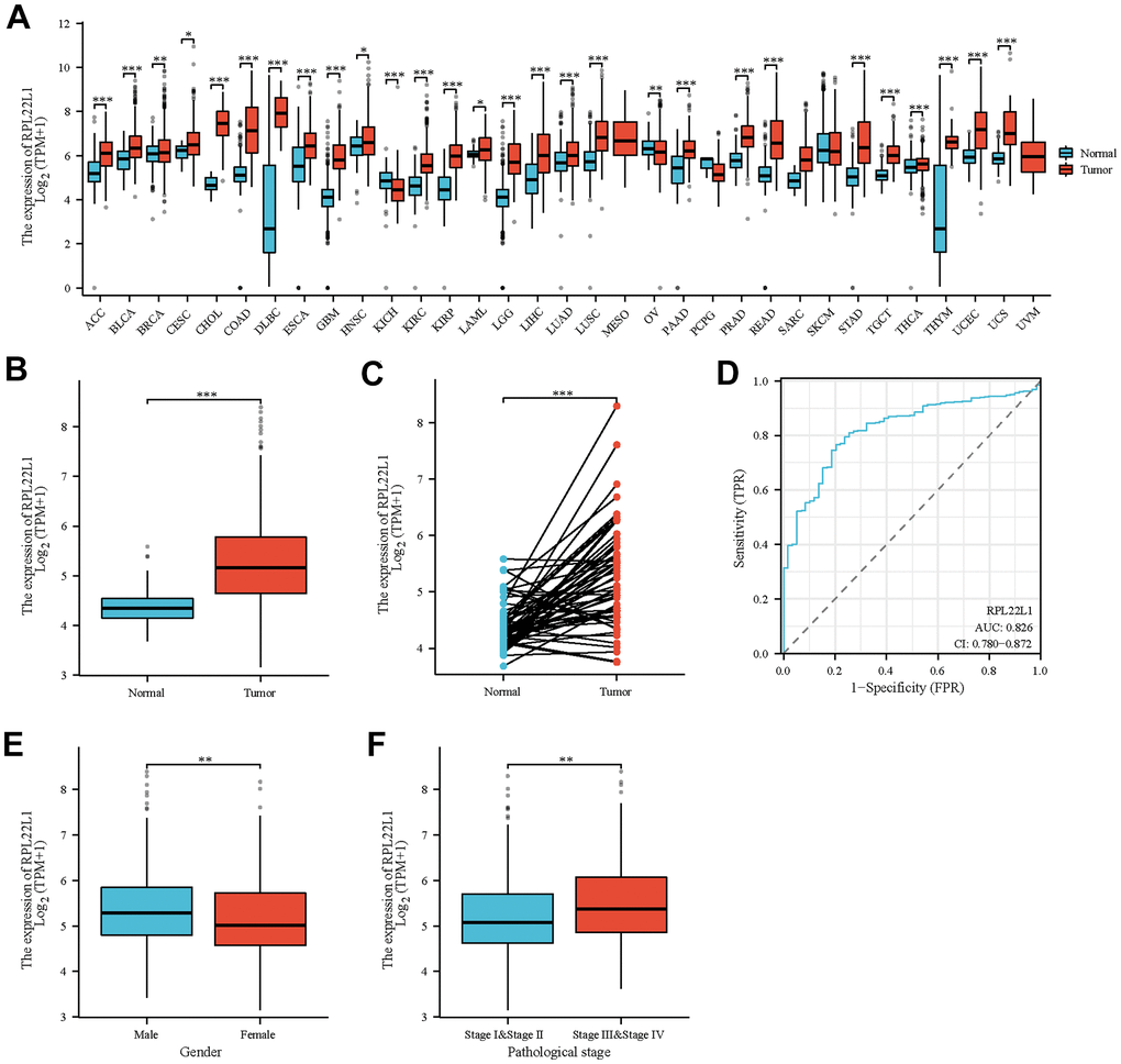 Abnormal expression of RPL22L1 in LUAD and its correlation with various clinical features. (A) Differential expression of RPL22L1 in pan cancer and normal tissues. (B) Specific differential expression of RPL22L1 in LUAD and normal lung tissue. (C) Differential expression of RPL22L1 in LUAD and its paired normal lung tissues. (D) The efficacy of RPL22L1 expression in distinguishing LUAD tissue from non-tumor tissue is shown by the ROC curve. (E, F) represent T stage and pathological stage, respectively. The statistical significance is represented by *, p 