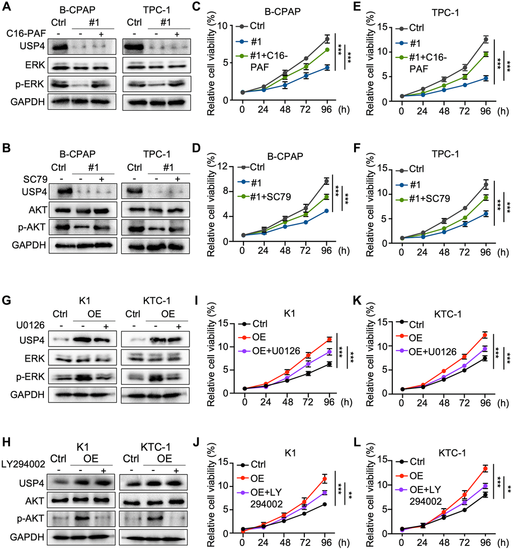 MAPK and AKT pathway inhibitors and agonists reverse the impact of USP4 in PTC. (A, B) Western blot analysis for detecting USP4, ERK, AKT, phosphorylated ERK, and phosphorylated AKT in B-CPAP and TPC-1 cells after USP4 knockdown and subsequent treatment with C16-PAF (10 μM for 24 h) or SC79 (4 μg/mL for 24 h); (C–F) CCK-8 assay to evaluate the proliferative capacity of B-CPAP and TPC-1 cells after USP4 knockdown and subsequent treatment with C16-PAF (10 μM for 24 h) or SC79 (4 μg/mL for 24 h); (G, H) Western blot analysis to detect USP4, ERK, AKT, phosphorylated ERK, and phosphorylated AKT in K1 and KTC-1 cells overexpressing USP4 after treatment with U0126 (20 μM for 24 h) or LY294002 (50 μM for 24 h); (I–L) CCK-8 assay to evaluate the proliferative capacity of K1 and KTC-1 cells overexpressing USP4 after treatment with U0126 (20 μM for 24 h) or LY294002 (50 μM for 24 h). All *p **p ***p ****p 