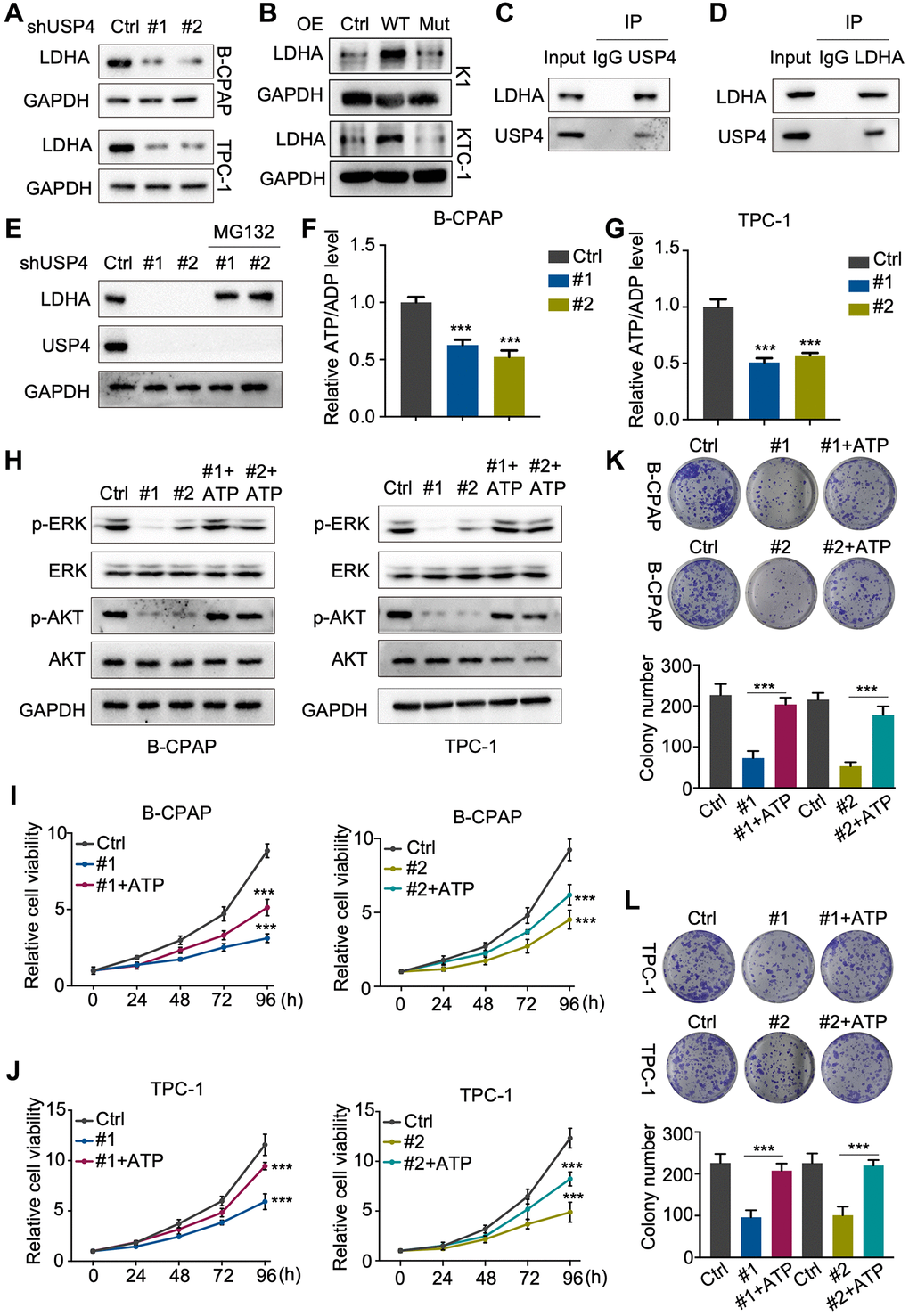 USP4 enhances PTC proliferation by stabilizing LDHA. (A, B) Western blot analysis to detect LDHA following USP4 knockdown in B-CPAP and TPC-1 cells or USP4 overexpression in K1 and KTC-1 cells; (C, D) B-CPAP cells were lysed with RIPA buffer. The lysates were immunoprecipitated with anti-IgG, anti-USP4, or anti-LDHA antibodies, followed by Western blot analysis with the specified antibodies; (E) USP4-knockdown B-CPAP cells were treated with MG132 (10 μM) for 4 hours, followed by Western blot analysis using the specified antibodies to detect proteins; (F, G) ATP/ADP ratio assay revealed a reduction in the ATP/ADP ratio in B-CPAP and TPC-1 cells following USP4 knockdown; (H) Western blot assays were conducted to evaluate changes in ERK, phosphorylated ERK, AKT, and phosphorylated AKT levels in B-CPAP and TPC-1 cells following USP4 knockdown. A similar analysis was performed on B-CPAP and TPC-1 cells with USP4 knockdown subjected to ATP treatment (1 mM); (I, J) CCK-8 assay was utilized to evaluate the proliferative capacity of B-CPAP and TPC-1 cells following USP4 knockdown and subsequent ATP treatment; (K, L) Colony formation assays were conducted to investigate the proliferation potential of B-CPAP and TPC-1 cells following USP4 knockdown and subsequent ATP treatment (1 mM). All *p **p ***p ****p 