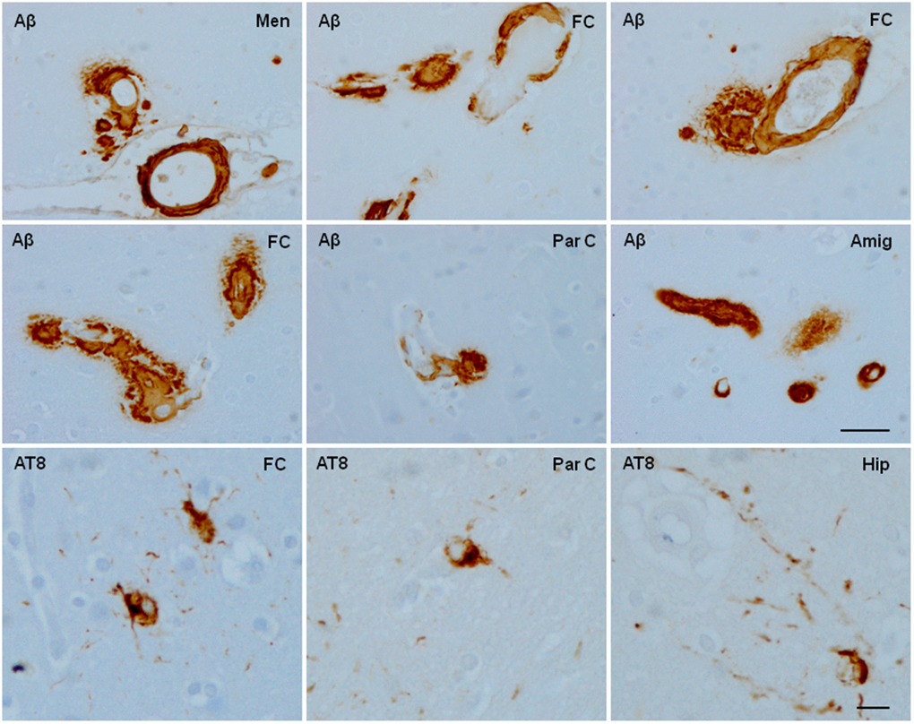 Aged cynomolgus monkey. Cerebral amyloid angiopathy involves blood vessels of the meninge (A), frontal cortex (FC), parietal cortex (Par C), and amygdala (Amyg) with additional β-amyloid (Aβ) deposition in the perivascular spaces. In contrast with the extensive cerebral amyloid angiopathy, a few neurons containing hyper-phosphorylated tau (antibody AT8) are scattered in the frontal and parietal cortex, and hippocampus. Paraffin sections slightly counterstained with haematoxylin. Upper two rows, bar = 180 μm; lower row, bar = 25 μm.