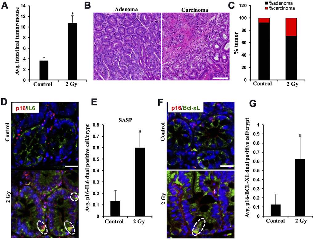 Low-LET radiation-induced tumor development in Apc1638N/+ mice is accompanied by an increased number of intestinal cells displaying senescence and SASP. (A) Intestinal-tumorigenesis at 150 days post-exposure (n=10 per group). Data presented as mean ± SEM, and * pB) Representative H&E-stained micrographs of intestinal adenoma and carcinoma. (C) Quantification of adenoma and carcinoma as a percentage of total tumors. (D) Representative immunofluorescence micrographs of intestinal epithelium showing p16 (red) and IL6 (green) dual positive SASP cells. (E) Quantification of p16 and IL6 dual positive cells. Data presented as mean ± SEM, and * pF). Representative immunofluorescence micrographs of intestinal epithelium showing p16 (red) and BCL-XL (green) dual positive senescent cells. (G). Quantification of p16 and BCL-XL dual positive cells. Data presented as mean ± SEM, and * p