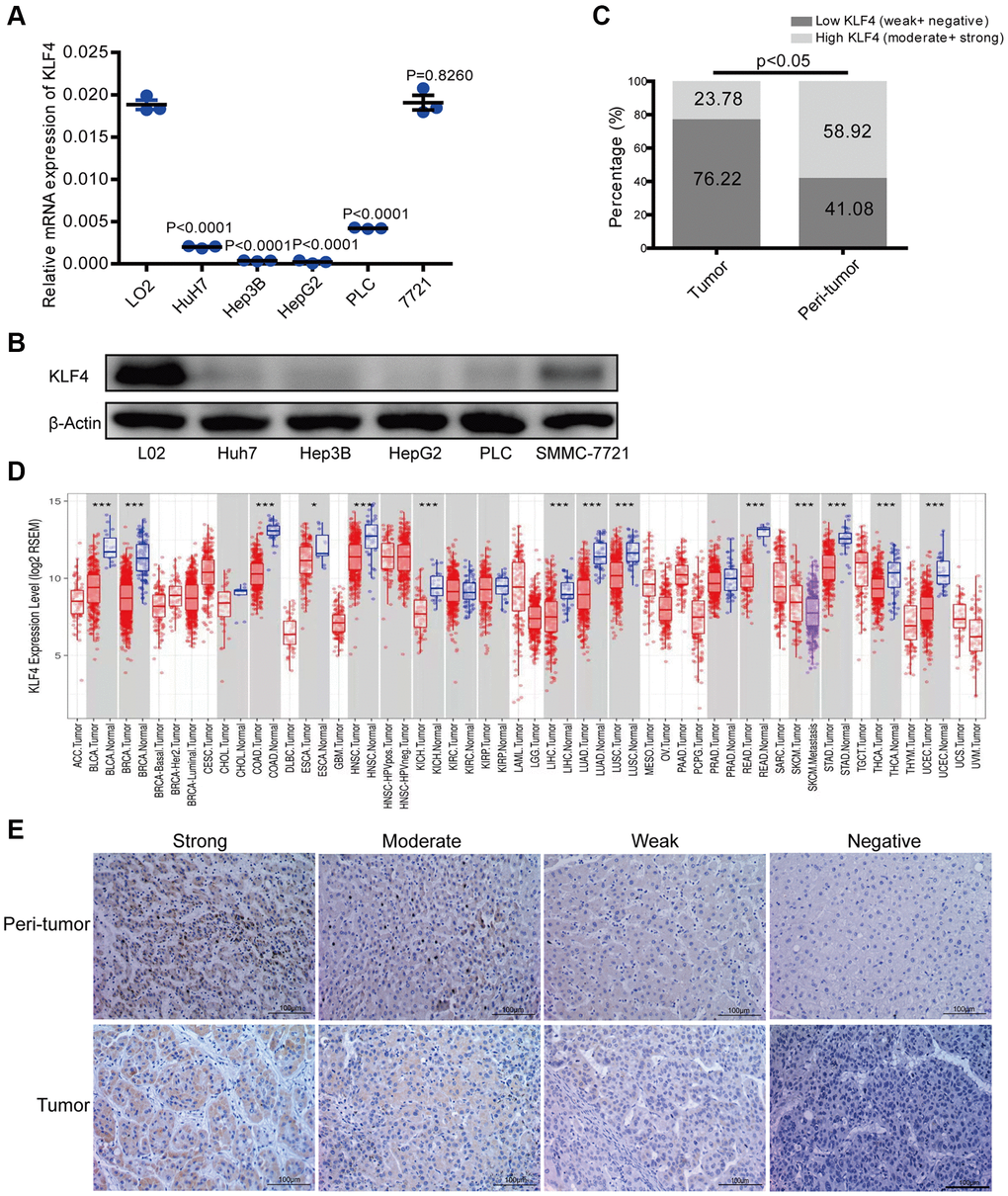 KLF4 expression in hepatocellular carcinoma (HCC) tissues and cell lines. (A) KLF4 expression was detected in the mRNA level among five HCC cell lines and one normal liver cell (L02). (B) KLF4 expression was detected in the protein level in six cell lines. The internal control was β-actin. (C) Immunohistochemical results were analyzed by chi-square test to compare the distribution of KLF4 in HCC tumors and adjacent tissues. (D) KLF4 expression was analyzed in tumor and para-tumorous tissues in TCGA tumors. (E) KLF4 expression was exhibited through characteristic photos of immunostaining in HCC tumor and para-tumorous tissues. Image scale = 100 μm. P *P **P ***P 