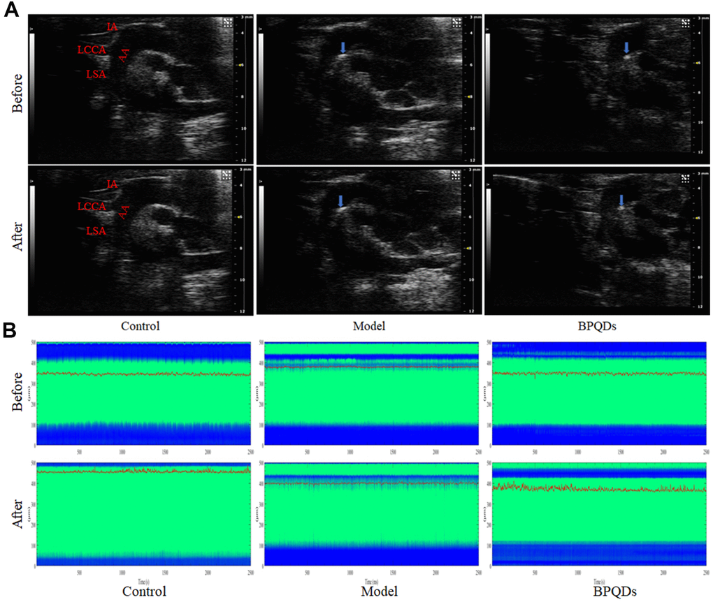 (A) Ultrasonography of the aortic plaque (blue arrow) before and after treatment. AA: Aortic arch, IA: Innominate artery, LCCA: Left common carotid artery, LSA: Left subclavian artery. (B) Comparison of photoacoustic microscopy images of abdominal aorta in mice after treatment. (Before: before the injection of vasodilator, After: after the injection of vasodilator, the green area between the blue bands indicates the internal diameter of the abdominal aorta, the red curve shows the change of the internal diameter of the abdominal aorta over time, and the corresponding ordinate is the internal diameter of the abdominal aorta).