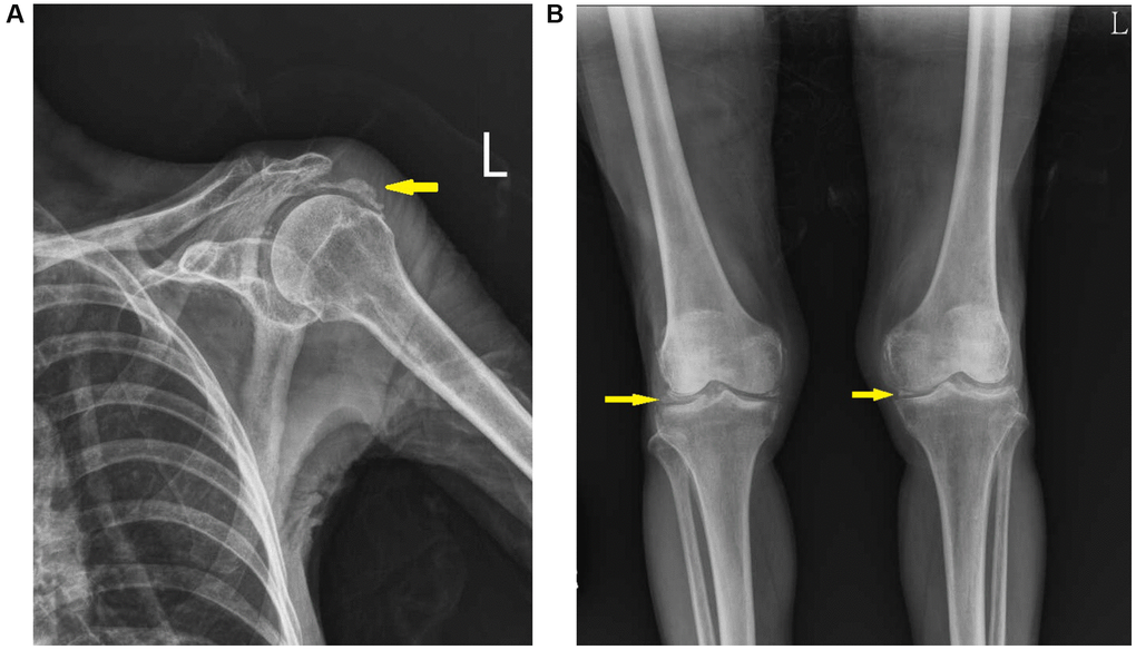 Radiographic image of the shoulder and knee joints. Calcifications were noted in the shoulder (A) and knee (B) joint space, compatible with chondrocalcinosis (yellow arrow).